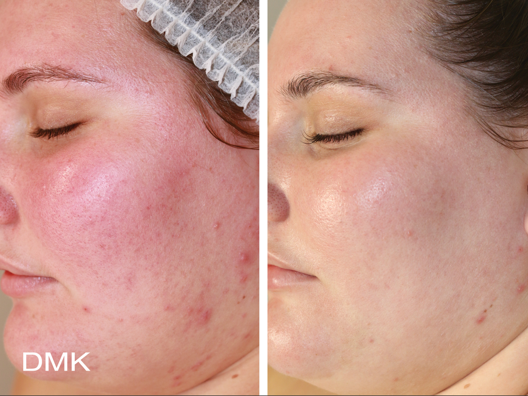 Reative Skin before and after 